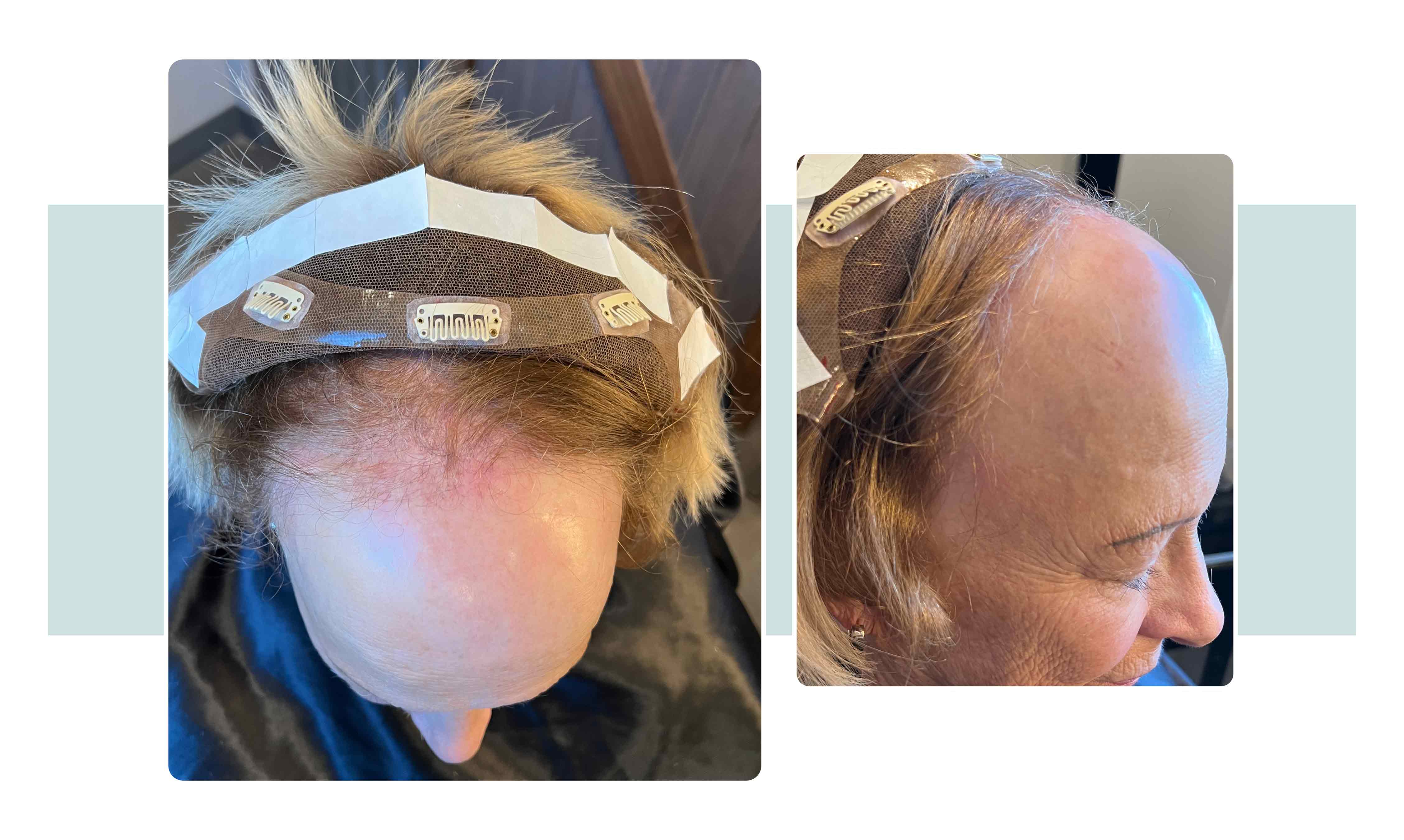 Images of hair systems for frontal fibrosing alopecia (FFA)