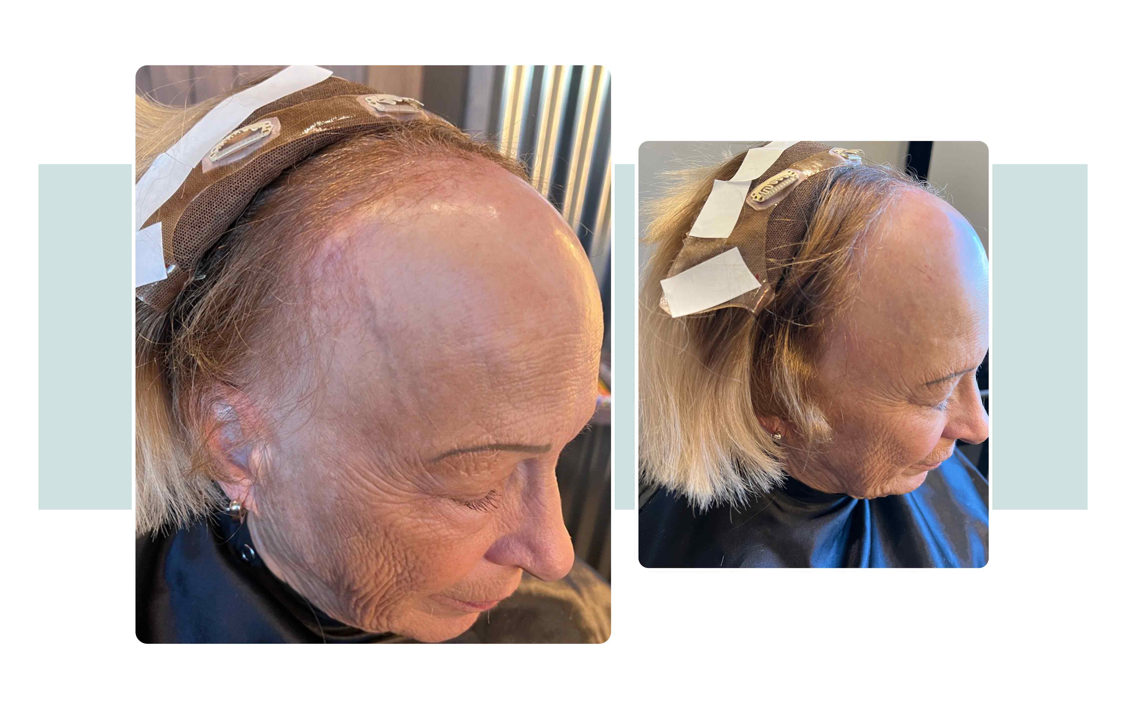 Images of frontal fibrosing alopecia (FFA)