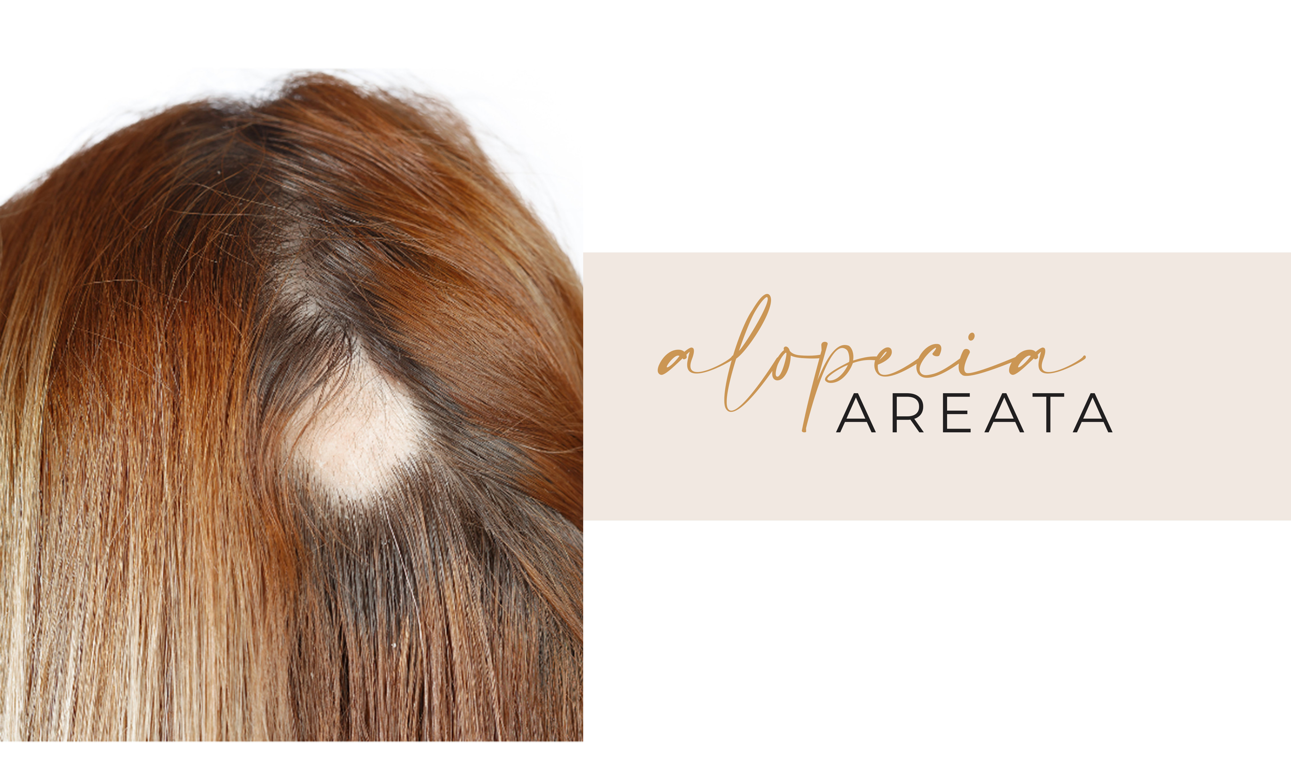 Alopecia Areata