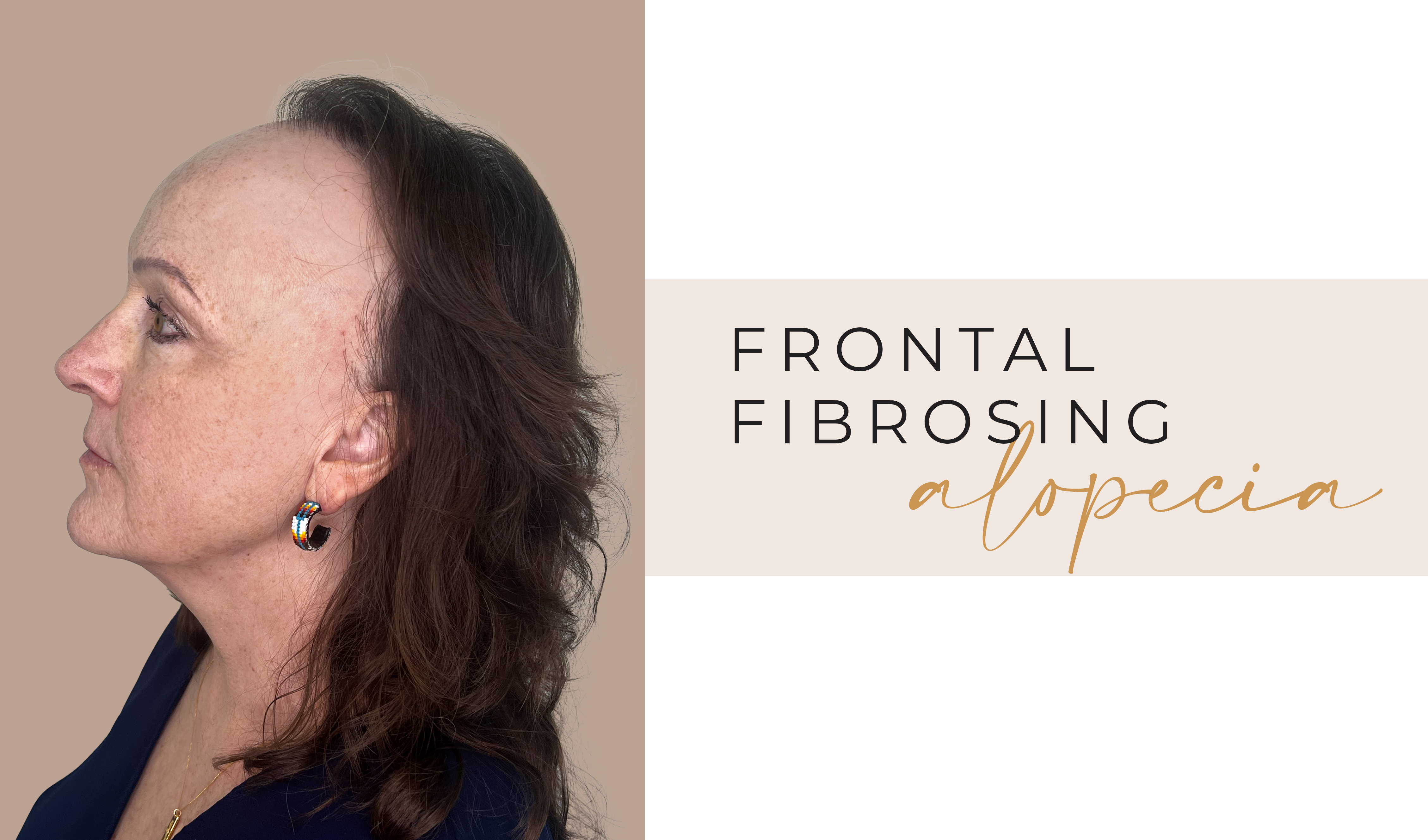 Frontal Fibrosing Alopecia