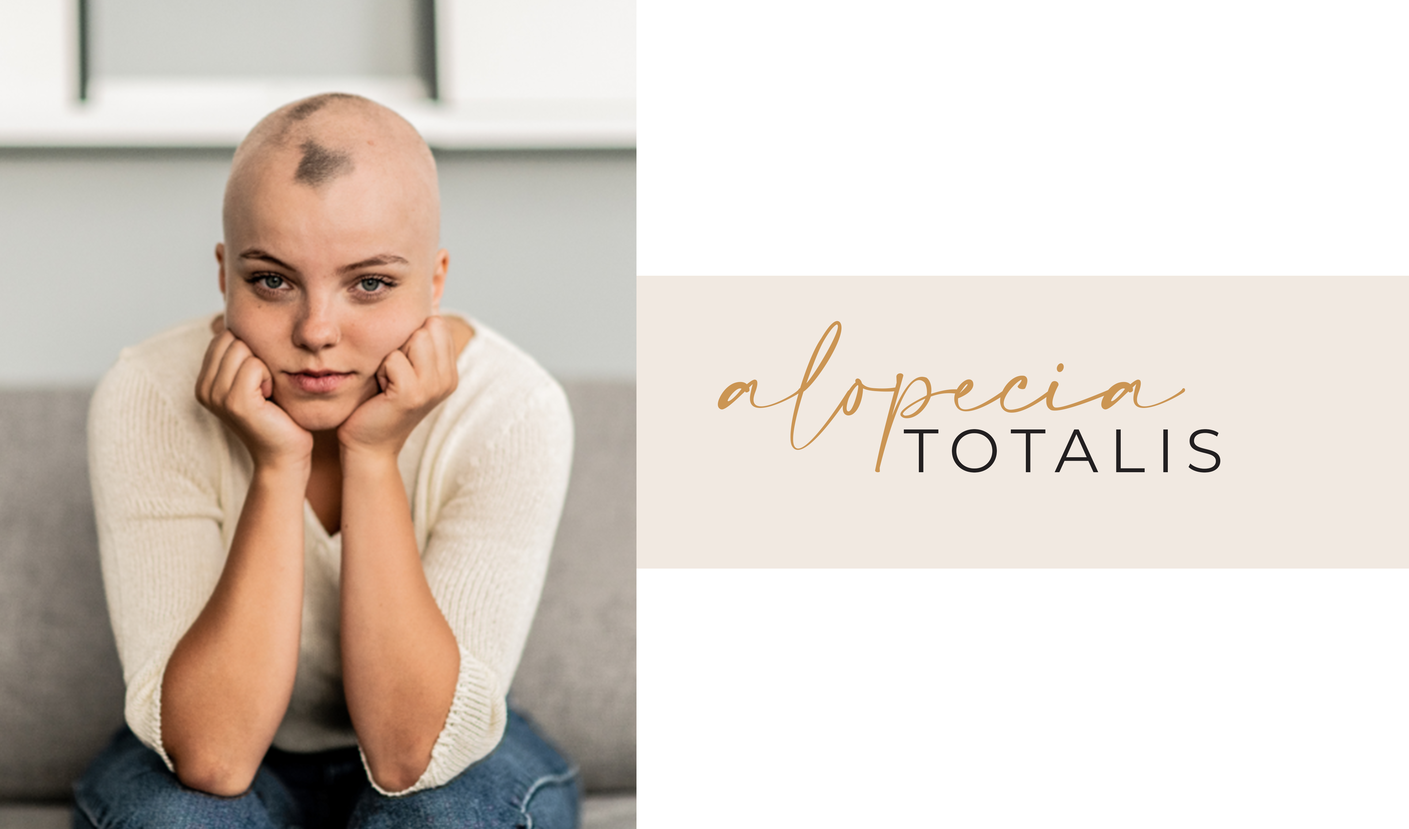 Alopecia Totalis