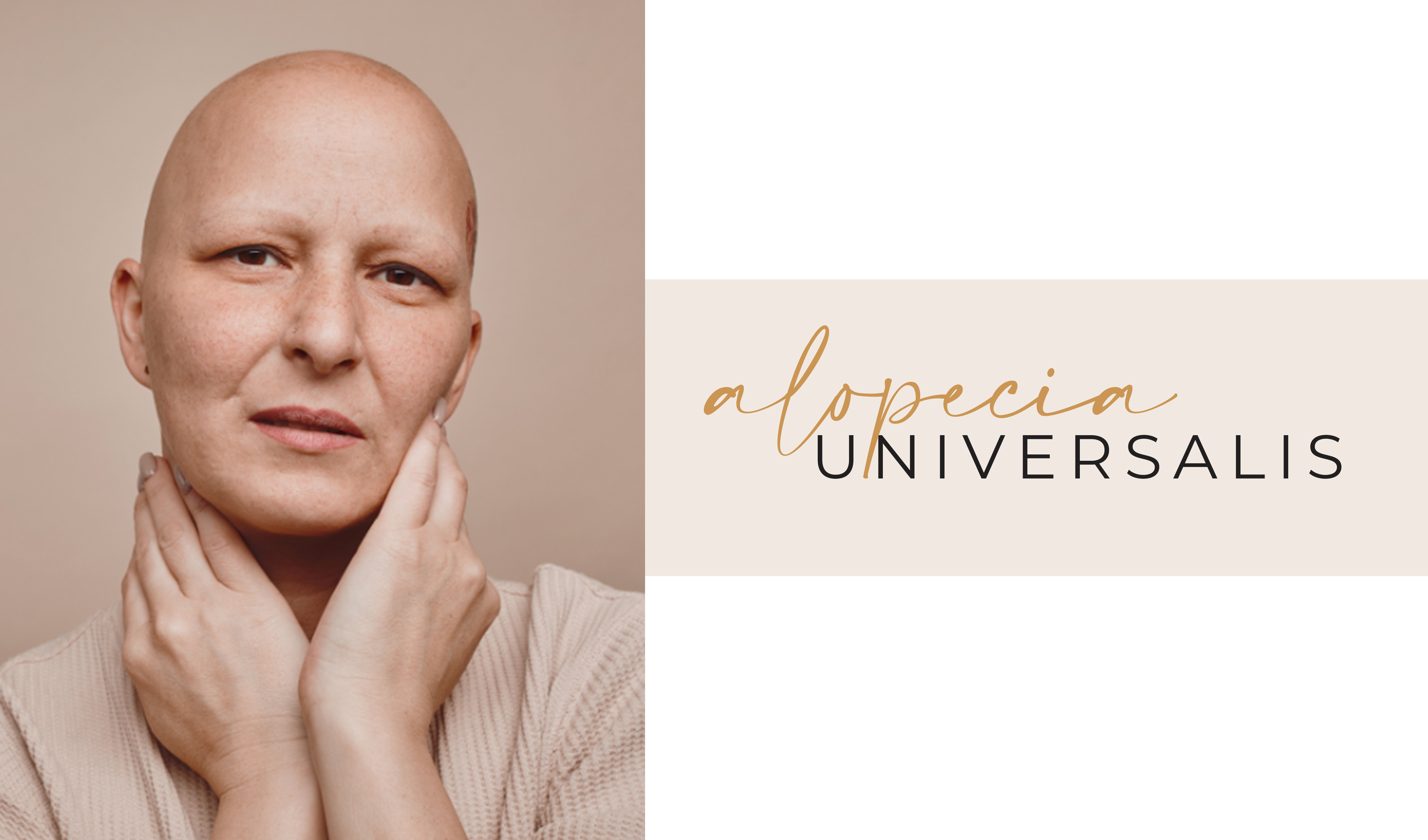 Alopecia Universalis