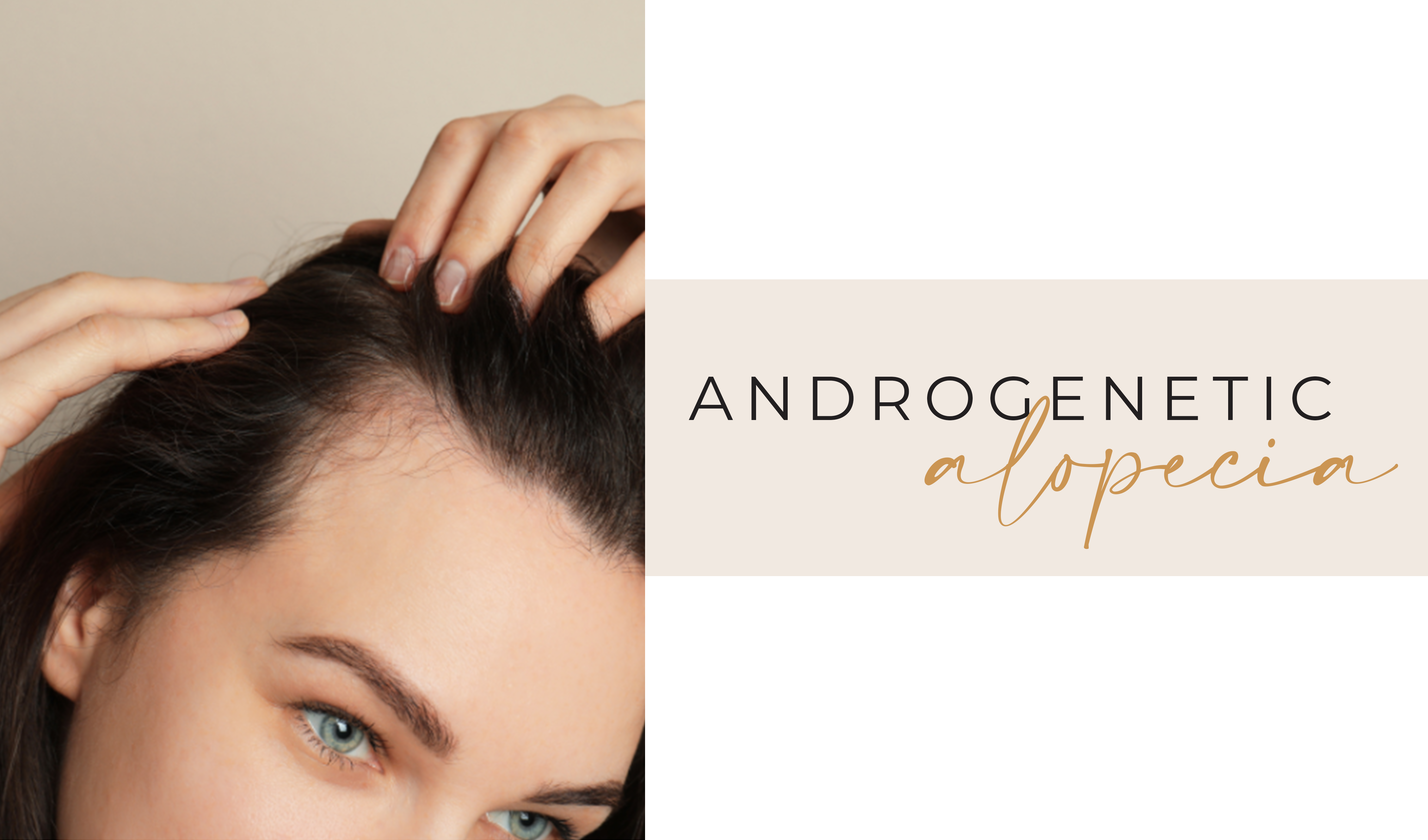 Androgenetic Alopecia