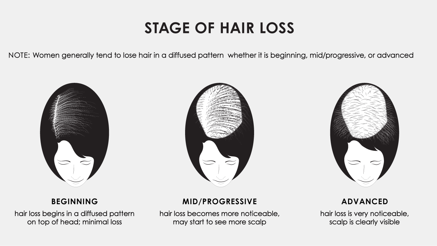 Stages of Hair Loss - Jon Renau Collection